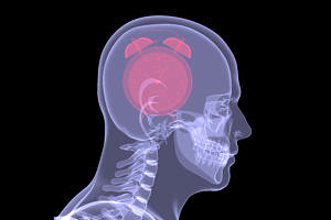 Towards entry "New recommended therapy for mechanical heart valves and intracerebral hemorrhage"